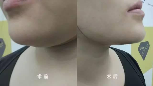 双下巴溶脂视频,轻松溶脂塑形视频教程