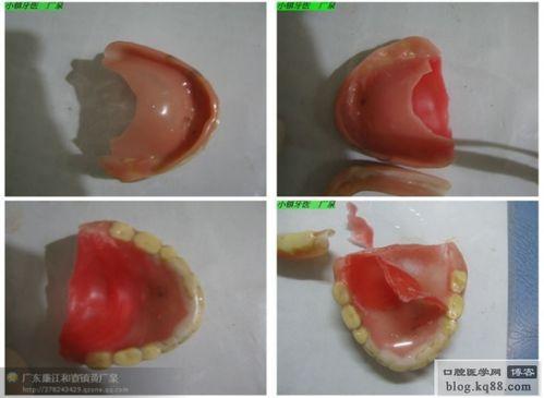 全口义齿取模视频,视频教学解析
